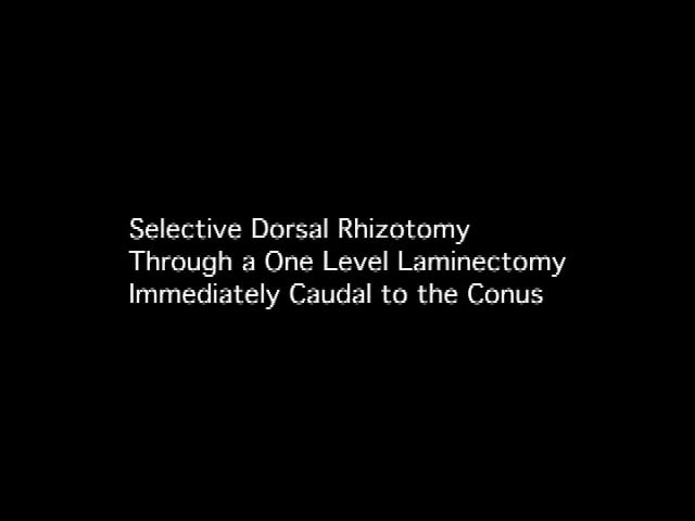 Selective Dorsal Rhizotomy (SDR) Through a One Level Laminectomy Immediately Caudal to the Conus