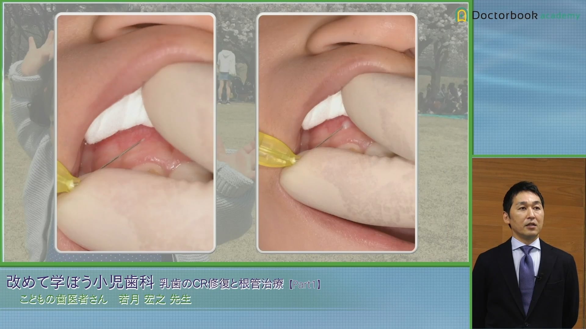 臨床知見録_乳歯のコンポジットレジン修復_針の太さ・刺入部位・針の向き