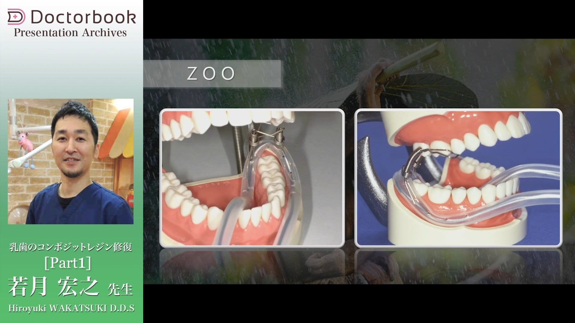 臨床知見録_乳歯のコンポジットレジン修復_簡易防湿ZOOの適応と使い方