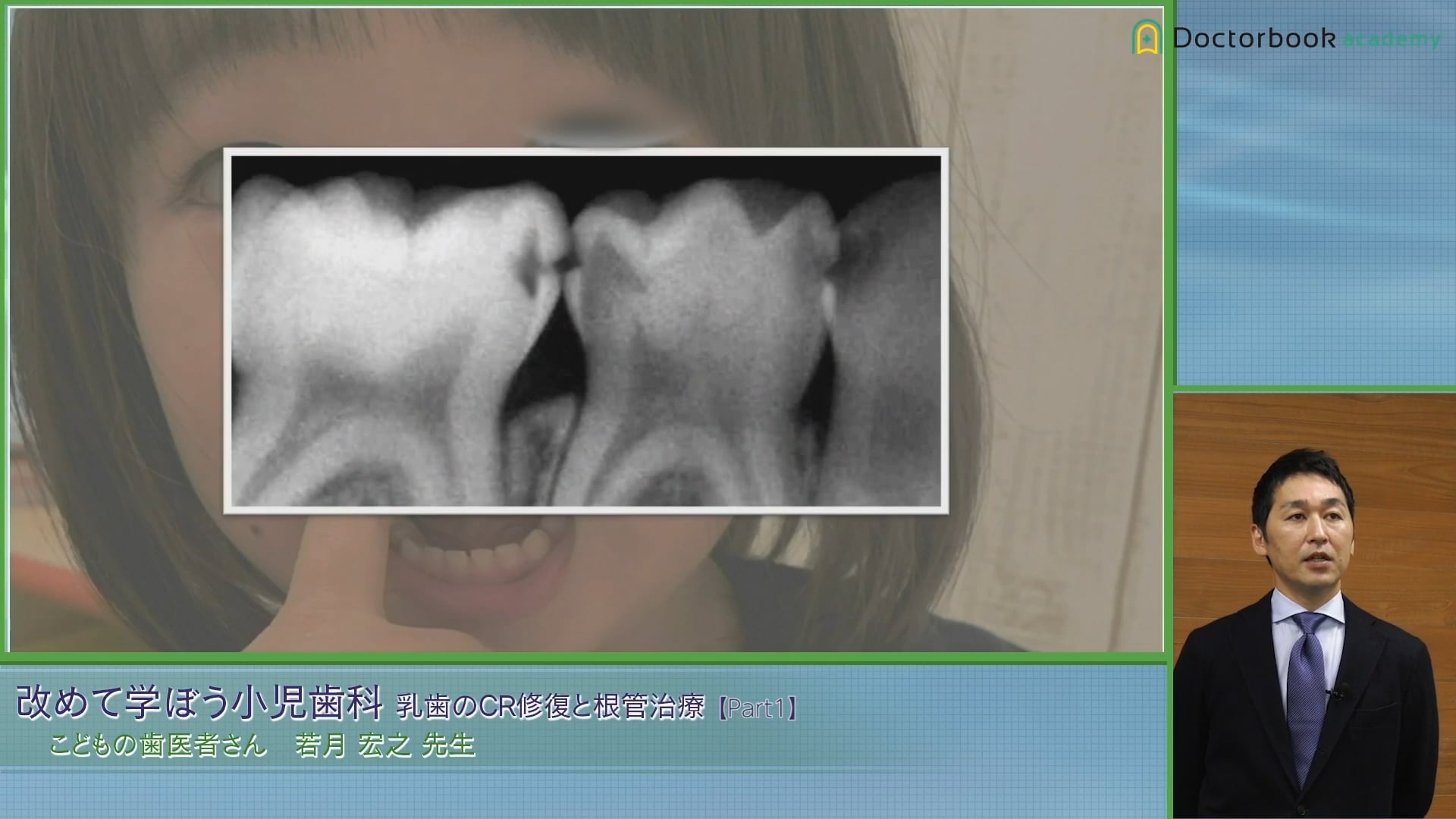 臨床知見録_乳歯のコンポジットレジン修復_隣接面う蝕はバイトウィング