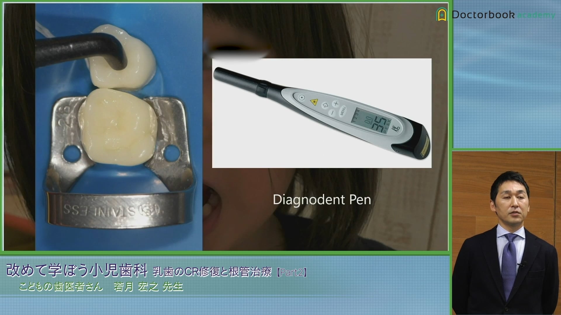 臨床知見録_乳歯のコンポジットレジン修復_裂溝診断は「清掃→ダイアグノデント」