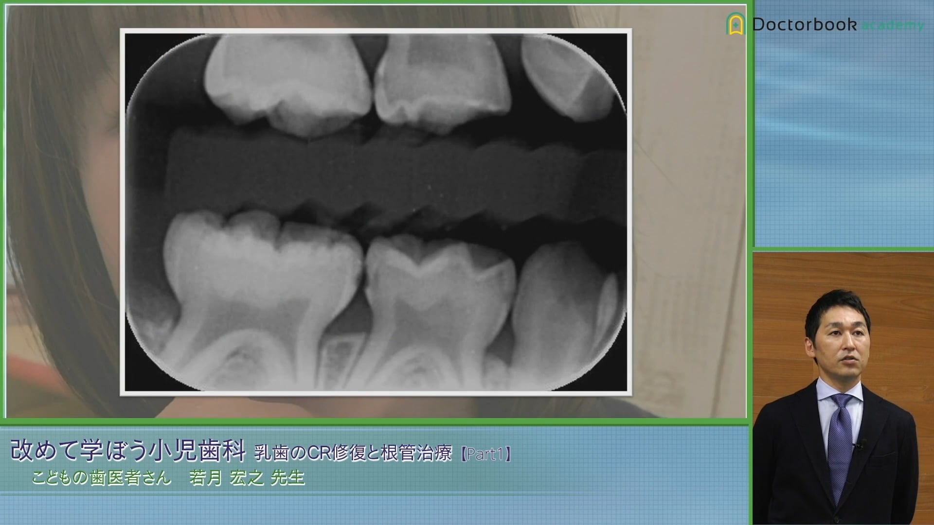 臨床知見録_乳歯のコンポジットレジン修復_サホライド（SDF）で経過観察する条件と注意