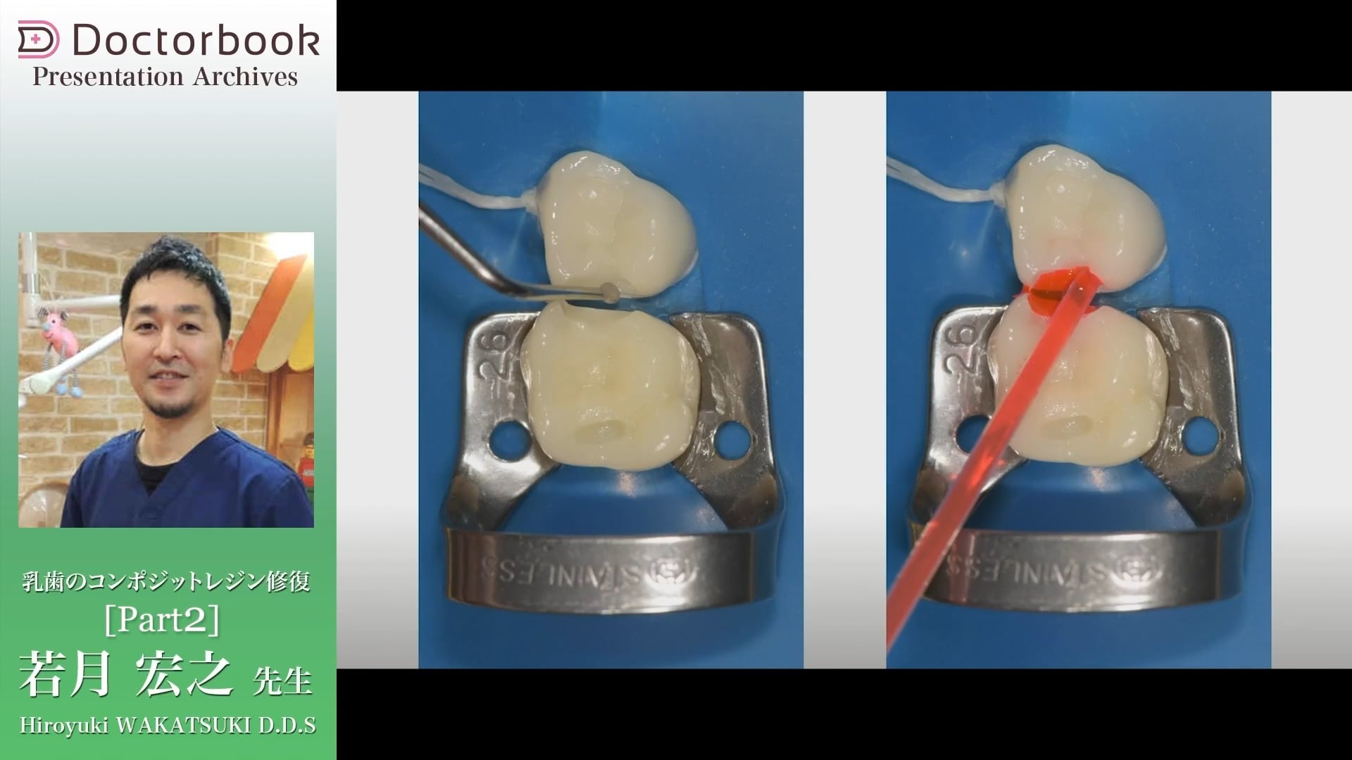 臨床知見録_乳歯のコンポジットレジン修復_タービンを避けて5倍速中心で形成する