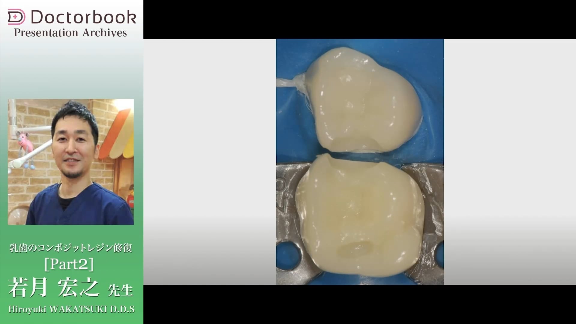 臨床知見録_乳歯のコンポジットレジン修復_辺縁隆線を残す