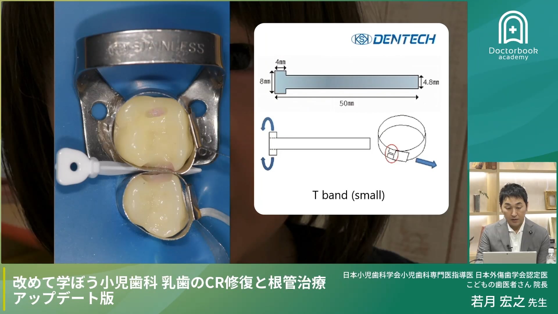 臨床知見録_乳歯のコンポジットレジン修復_マトリックスバンド