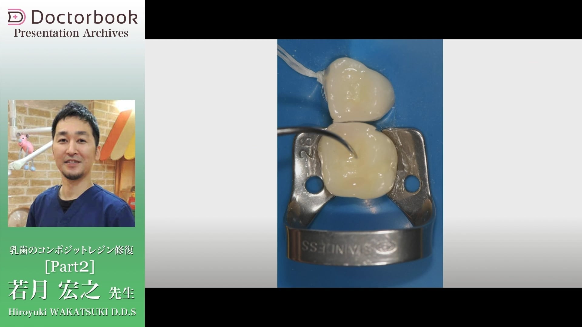 臨床知見録_乳歯のコンポジットレジン修復_充填は積層