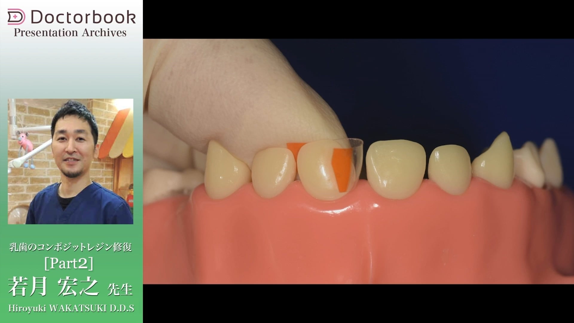 臨床知見録_乳歯のコンポジットレジン修復_ストリップスで行う乳前歯CR