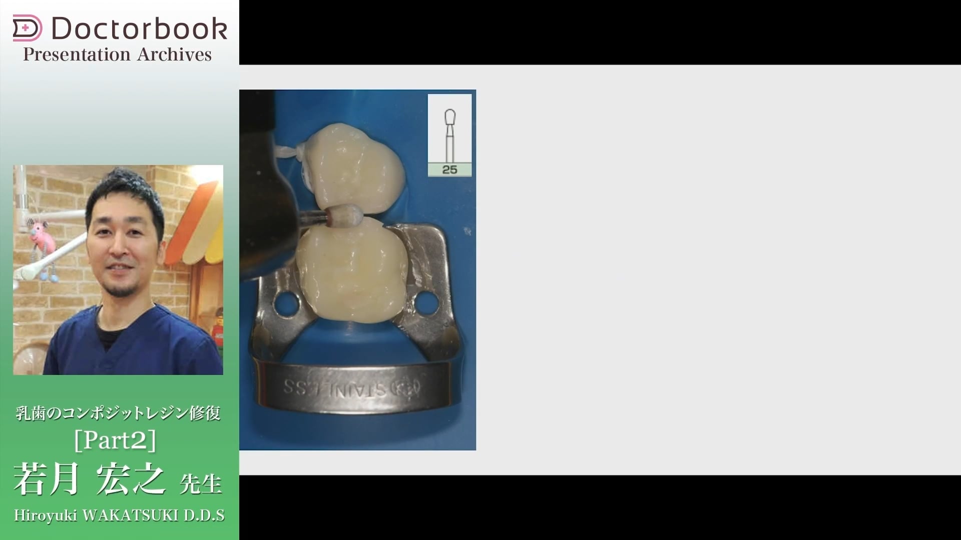 臨床知見録_乳歯のコンポジットレジン修復_乳歯の研磨ルーチン