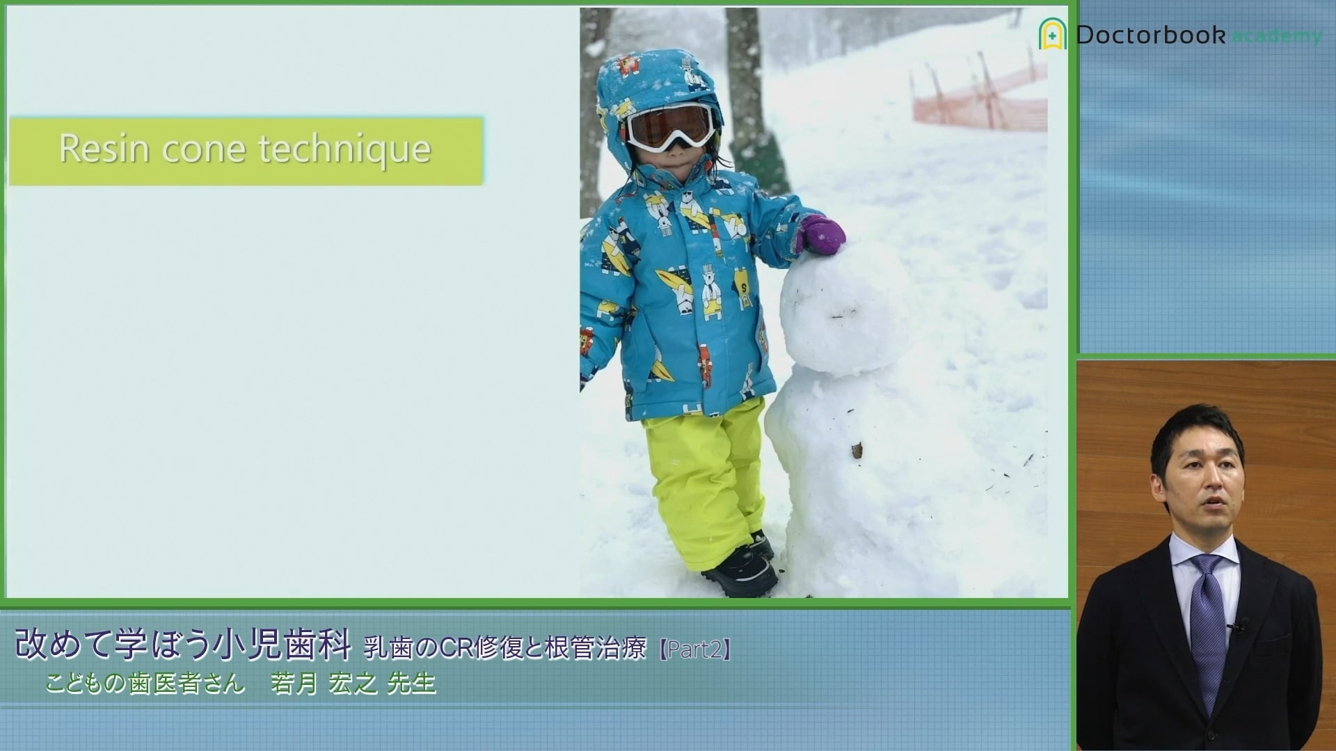 臨床知見録_乳歯のコンポジットレジン修復_Resin cone technique