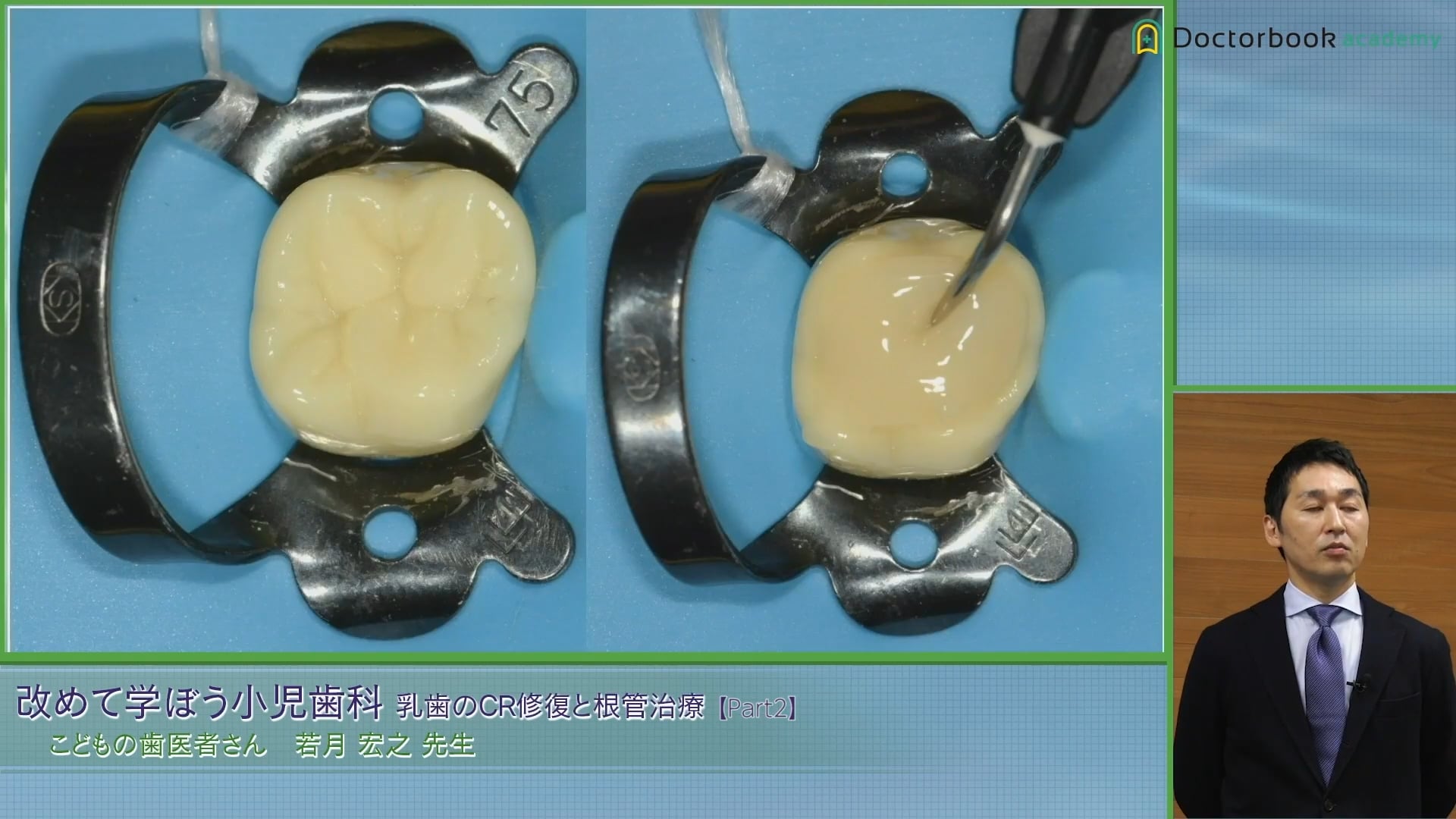 臨床知見録_乳歯のコンポジットレジン修復_Stamp technique