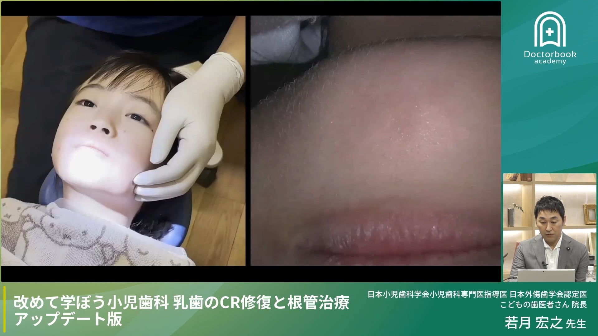 臨床知見録_乳歯のコンポジットレジン修復_簡易防湿ZOO