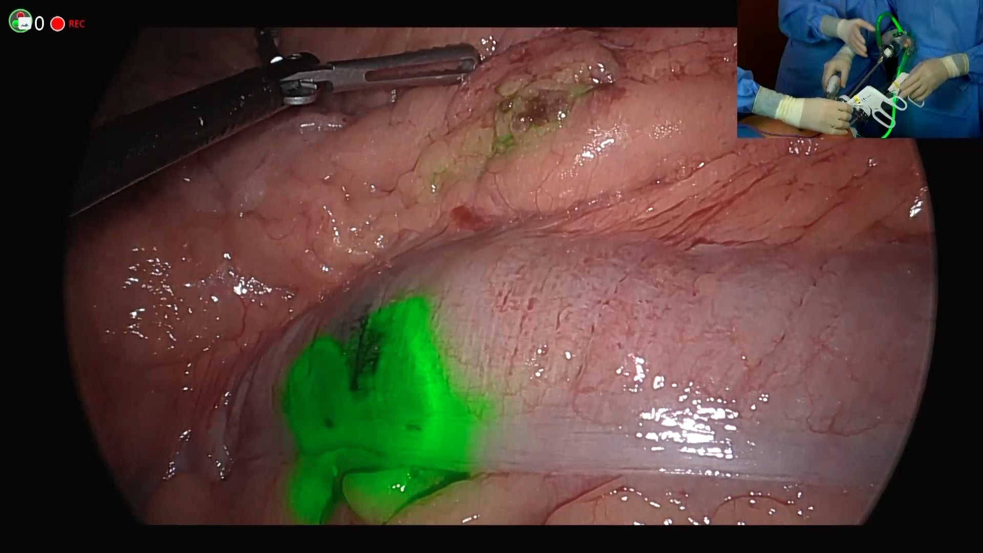 ICG-guided laparoscopic segmental transverse colectomy for early transverse colon cancer: a live procedure
