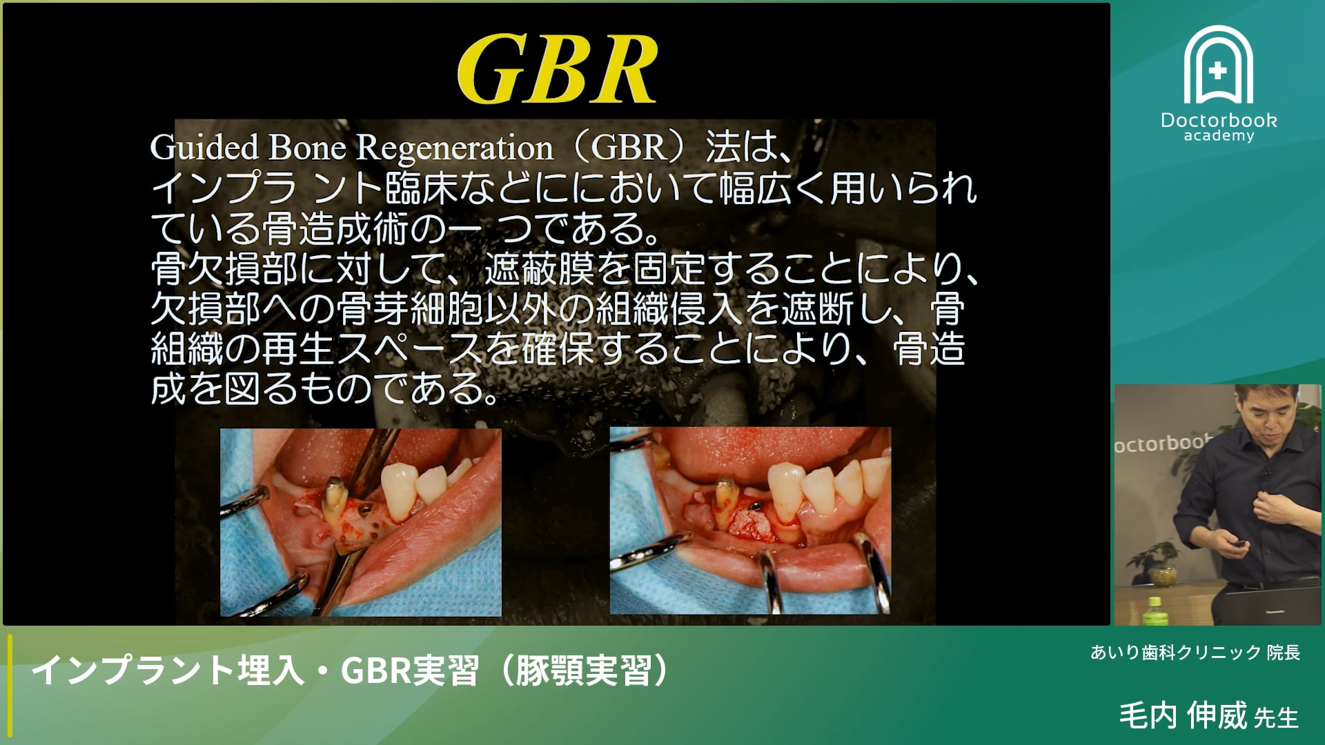 Part 3：GBRを成功させるためには？ ～骨造成の原理と外科テクニック～
