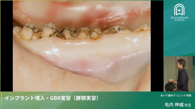 Part 4：GBR手技の実践デモンストレーション