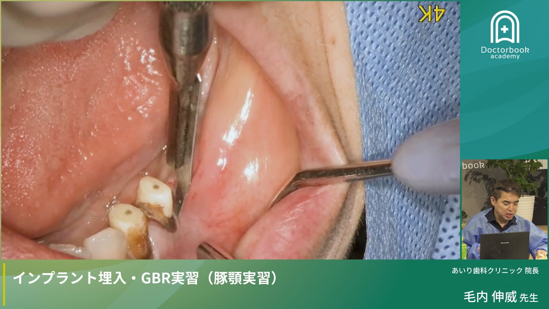 Part 5：症例動画で学ぶ骨造成とインプラント治療の実践