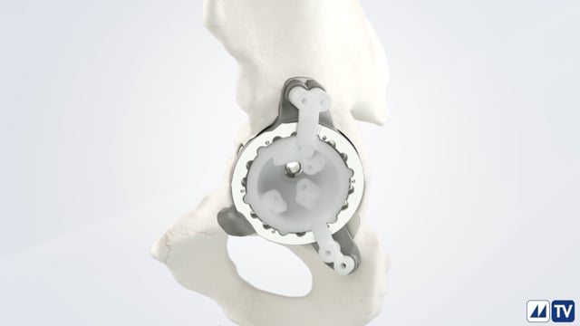 MyImplant Acetabular Reconstruction: custom solutions for uncustomary needs