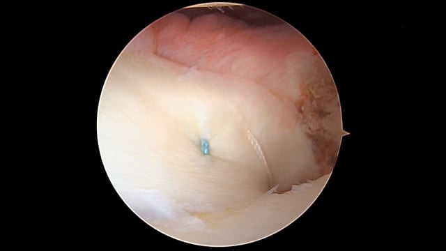 Double-Bundle PCL Reconstruction and Medial Meniscus Root Repair with Centralization