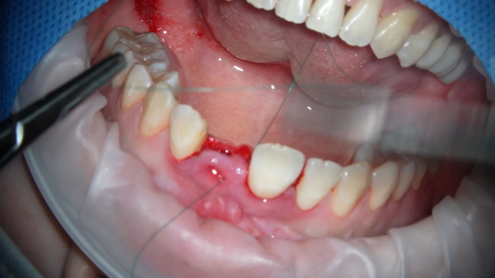 【GPB_implant_ua_050】縫合