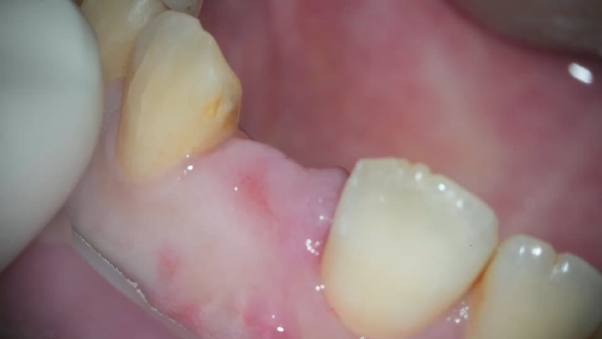 【GPB_implant_ua_010】術前
