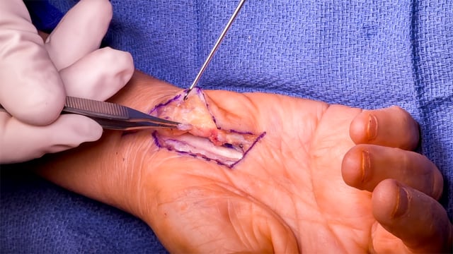 Hypothenar Fat Pad Flap for Recurrent Carpal Tunnel Syndrome