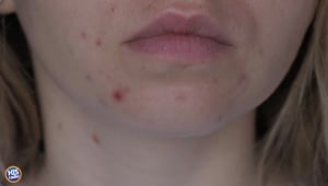 The Best Remedies For Zits