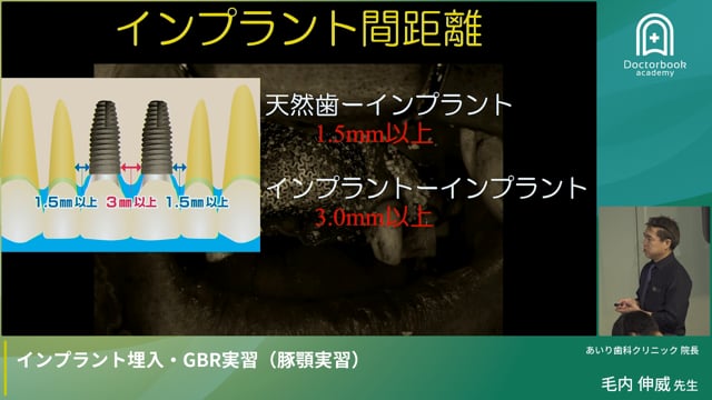 Part 1：インプラント治療を成功させるためには？ ～診査・診断と治療計画の基本～
