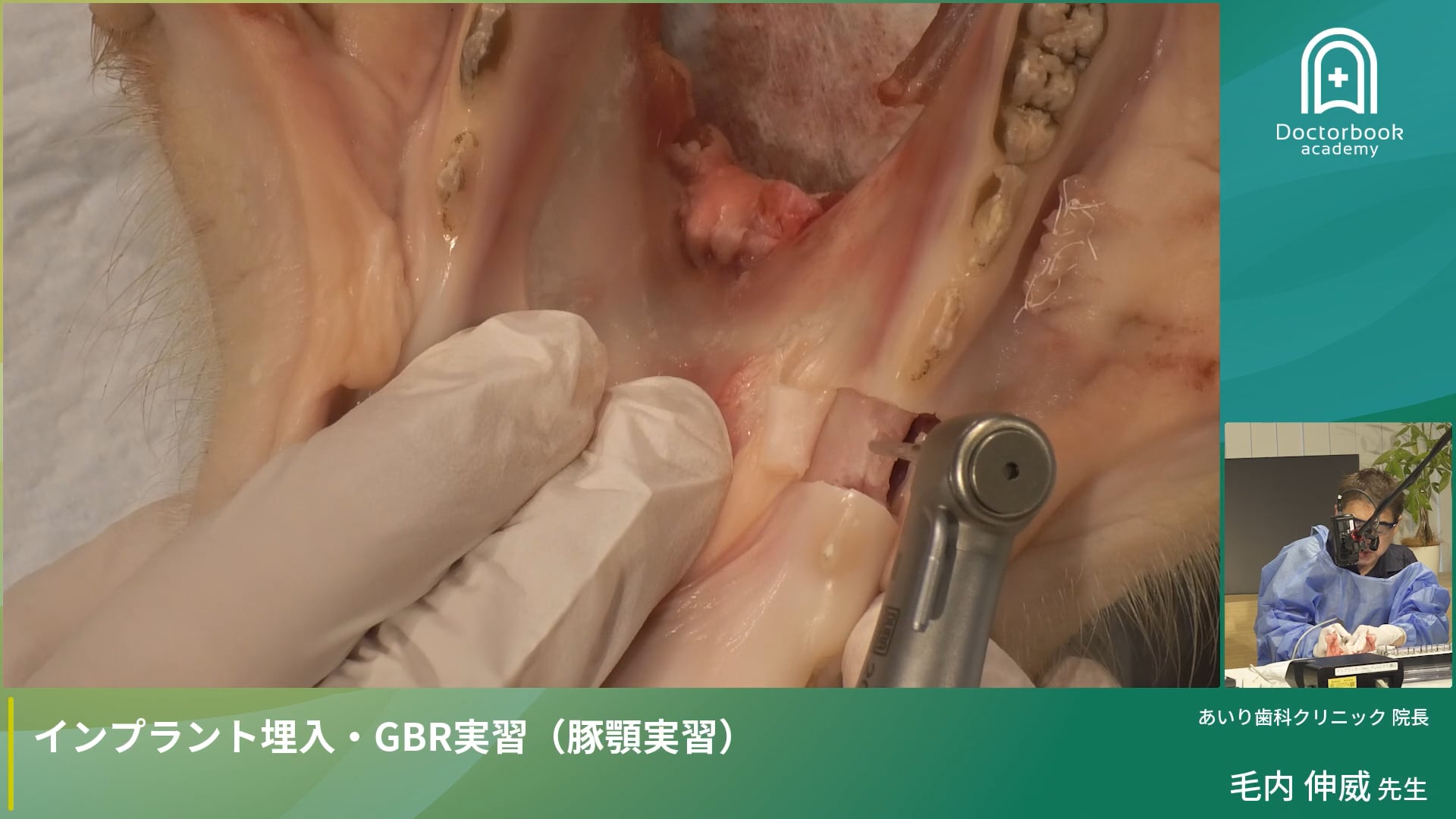 Part 2：インプラント埋入を成功させるためには？ ～外科基本手技と埋入プロトコル～