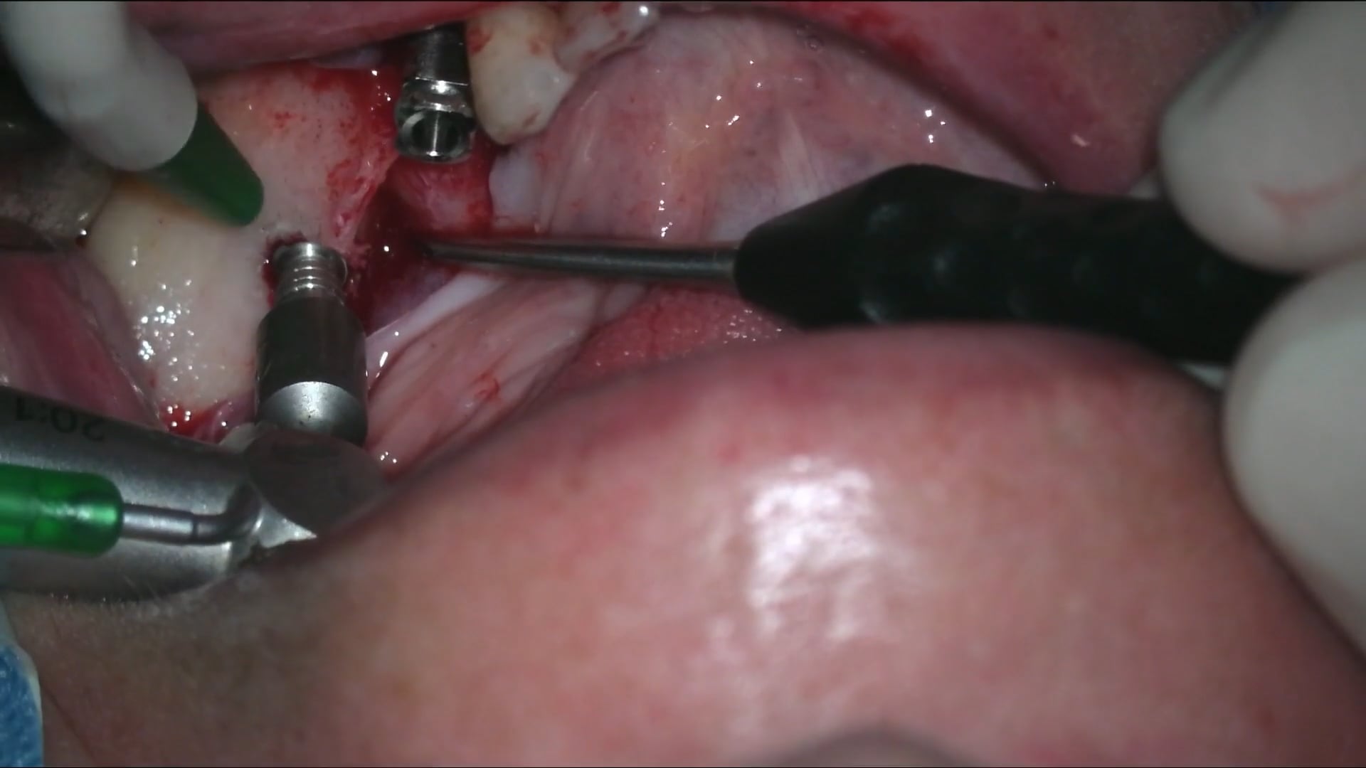 Colocación de implantes en 34 y 36 con ROG simultánea