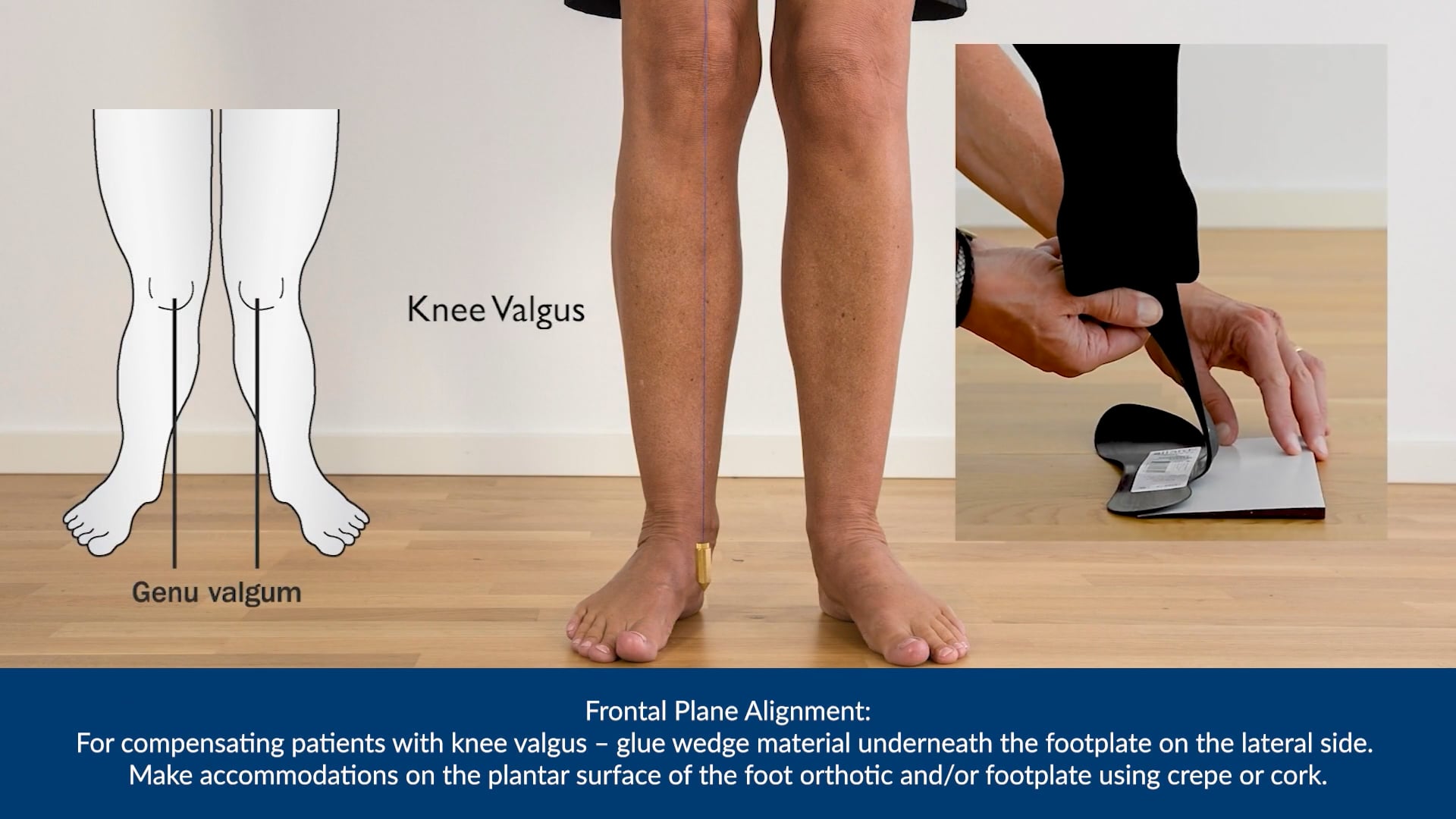 Allard AFO STEP 3: Foot Biomechanics
