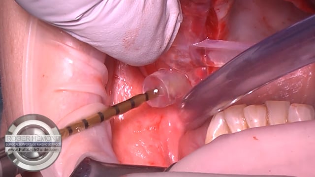 Guided Pterygoid Implant Success! R-35Ncm/L-80Ncm