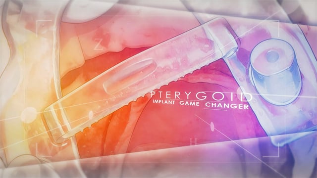 The Proven Pterygoid Implant Game Changer!