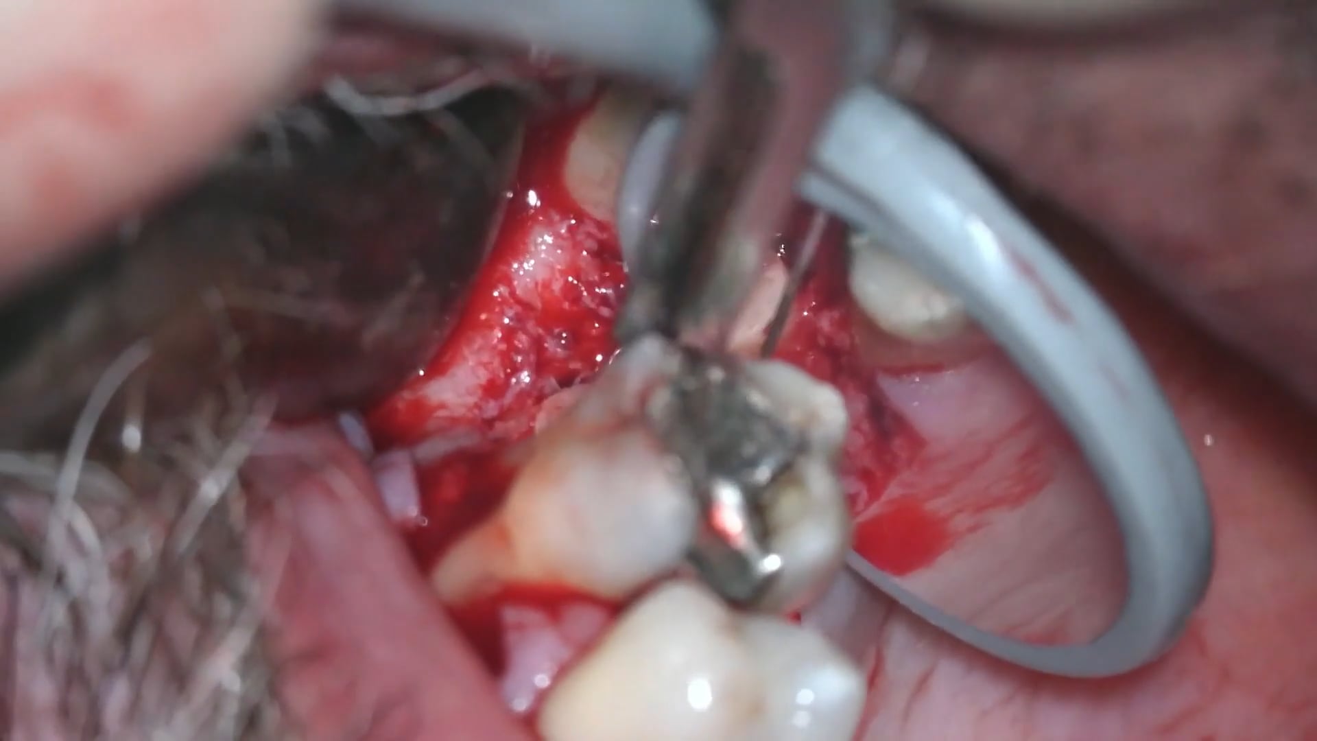 Cierre de comunicación orosinusal con tejido duro y blando