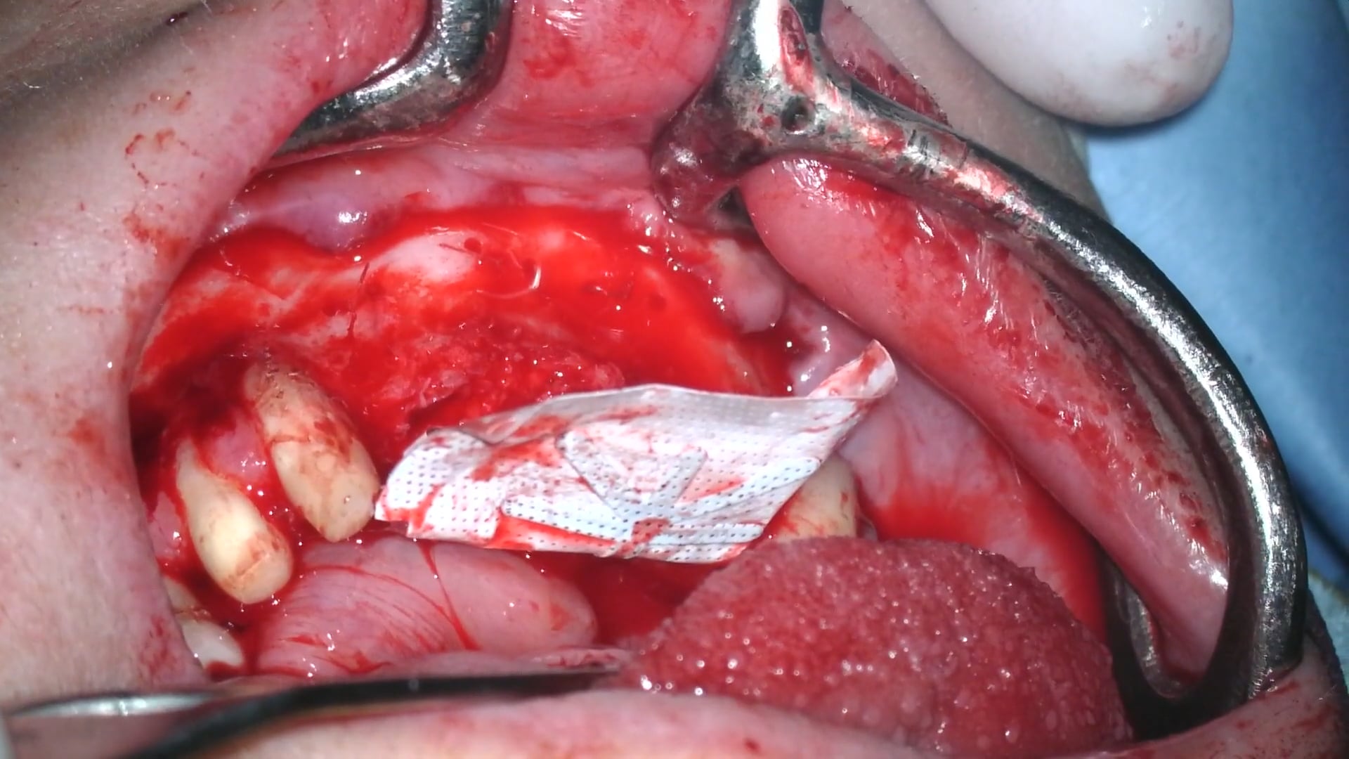 Injerto con aloinjerto cortical y autógeno en zona interforaminal