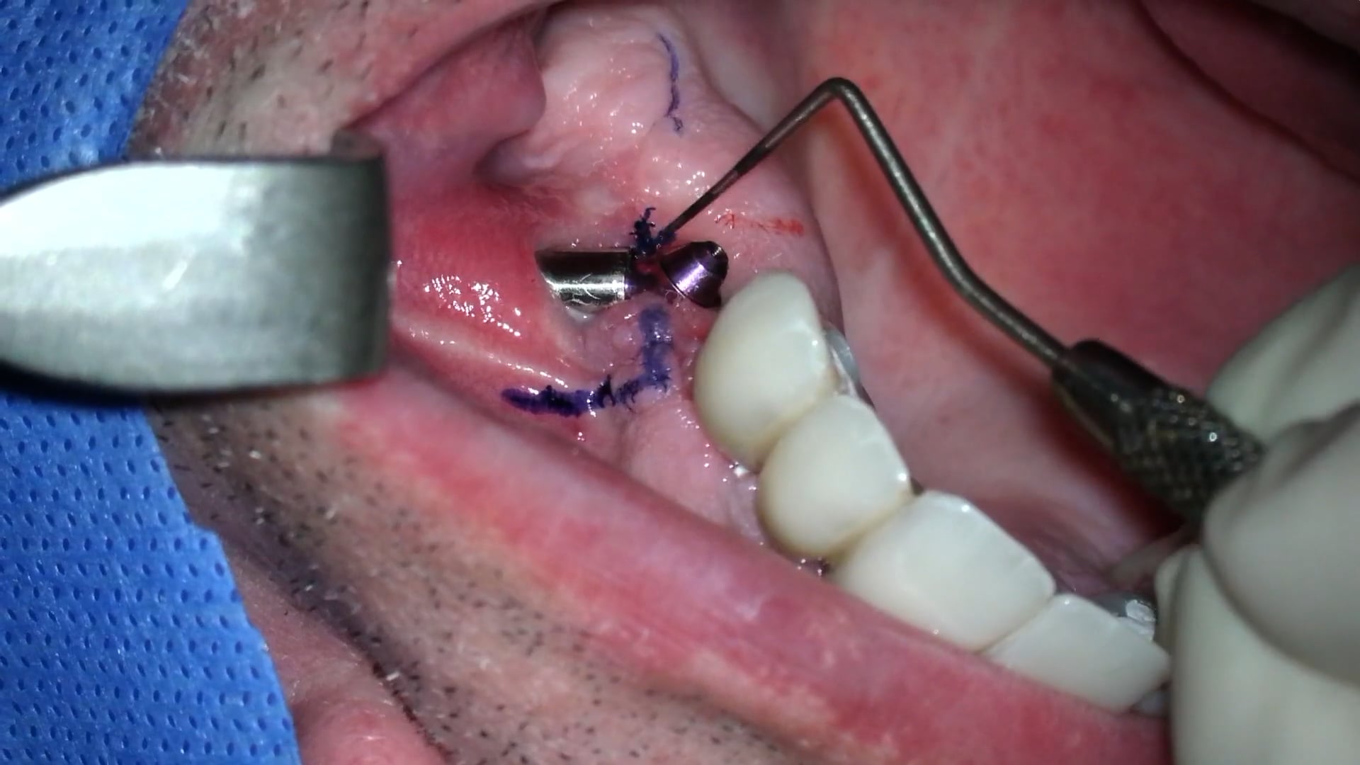 Manejo de tejido blando para intentar tapar exposición de parte coronal de implante cigomático