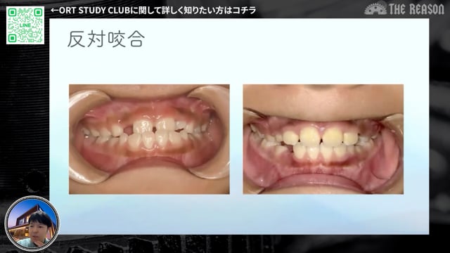 第37回 小学生の叢生・反対咬合を改善した小児矯正症例