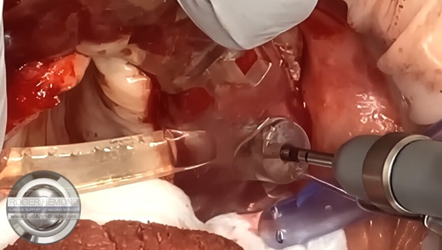 Guided Pterygoid Implant Case - Rescuing a Failed All on X