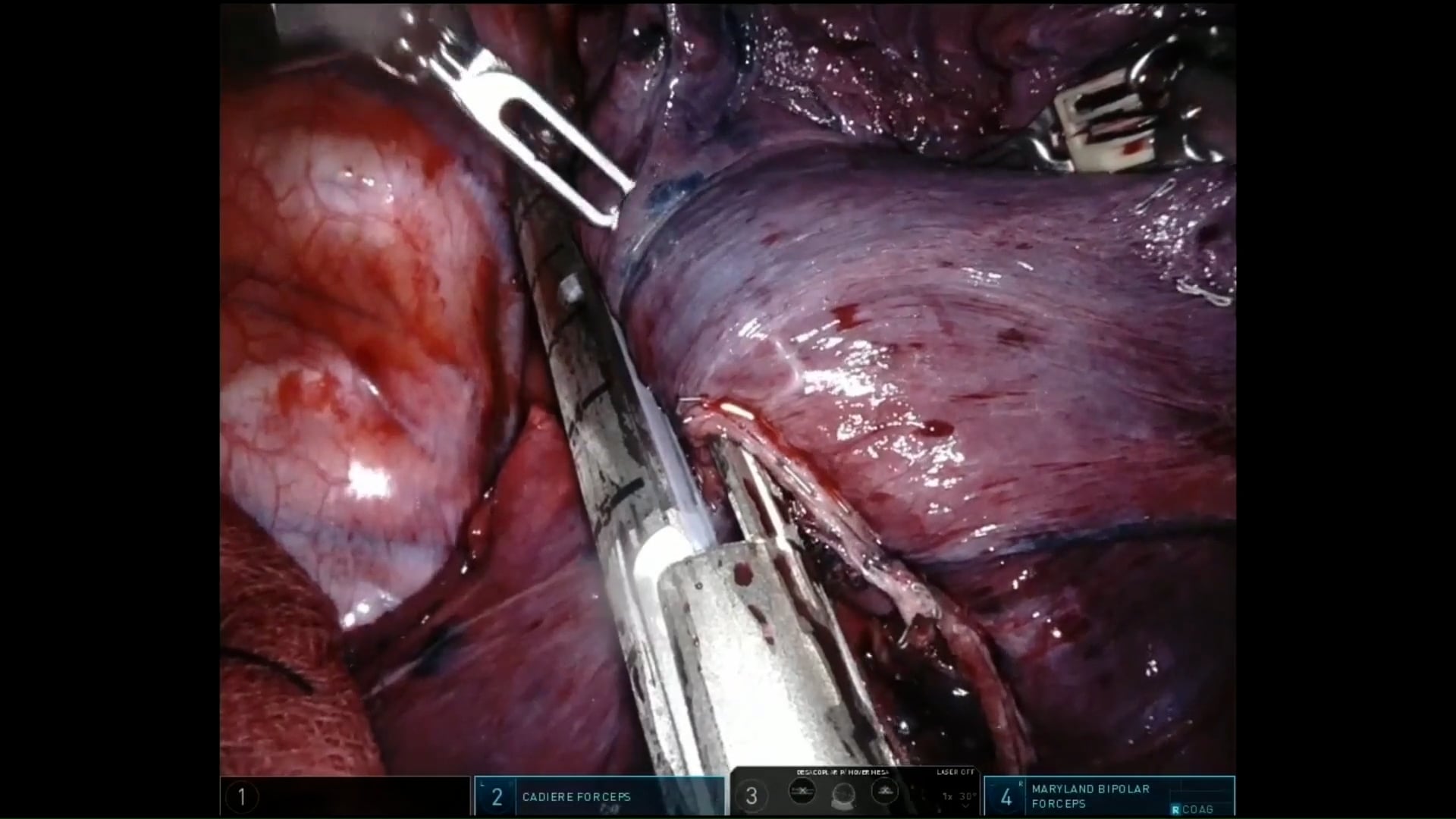 Robotic lobectomy for synchronous right upper lobe adenocarcinomas: technique and histopathological findings