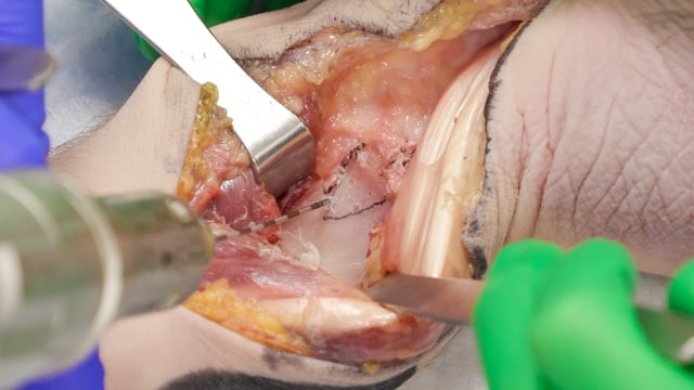 Corrective Osteotomy of Distal Radius Malunion
