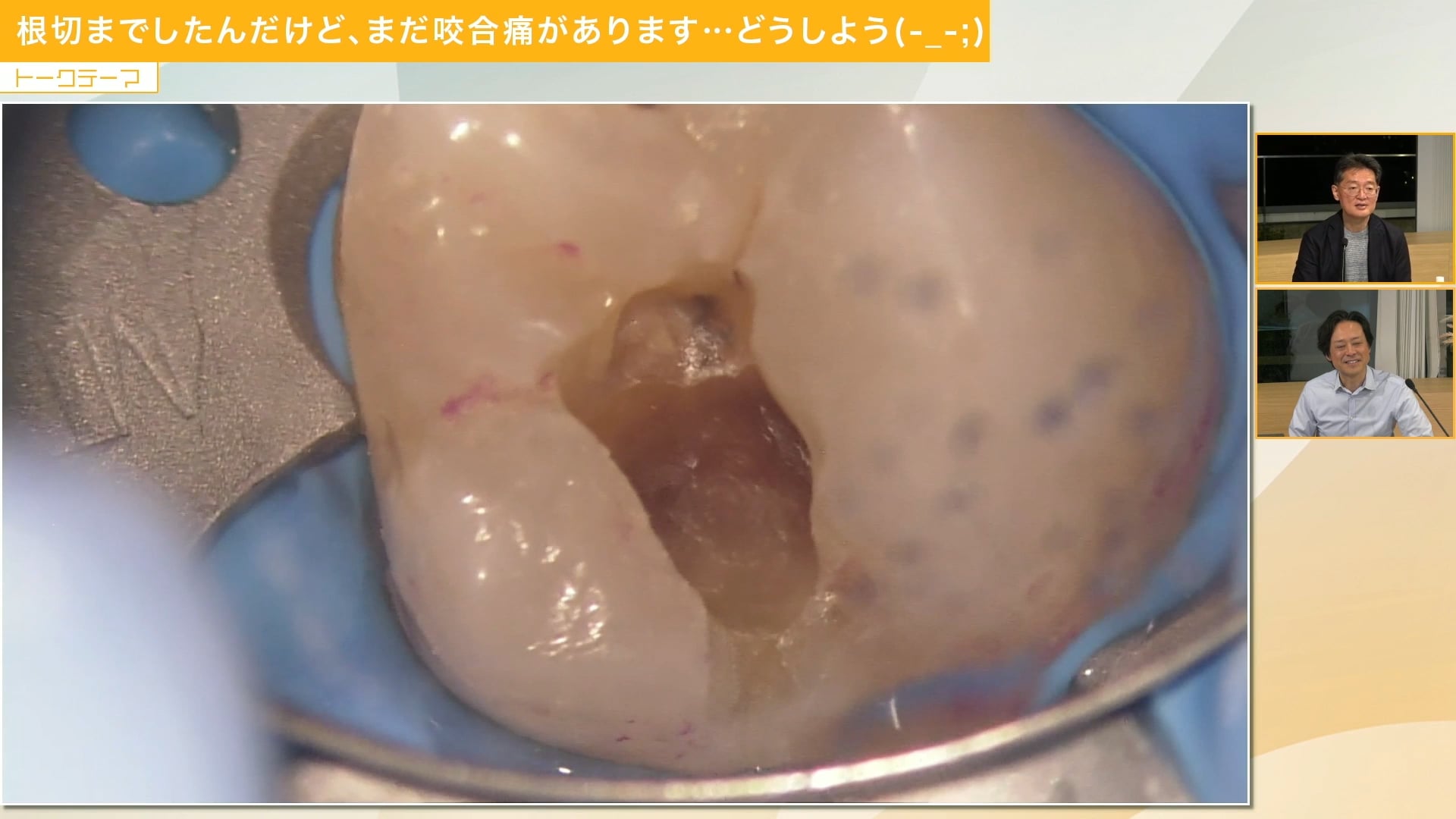 根切までしたんだけど、まだ咬合痛があります…どうしよう(-_-;)