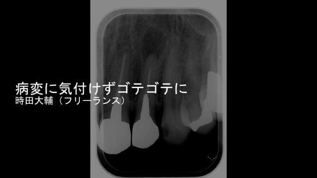 病変に気づけずゴテゴテに｜時田大輔先生(Topics)