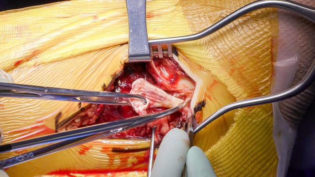 Ankle Syndesmotic Injury with Posterior Tibial Tendon Rupture