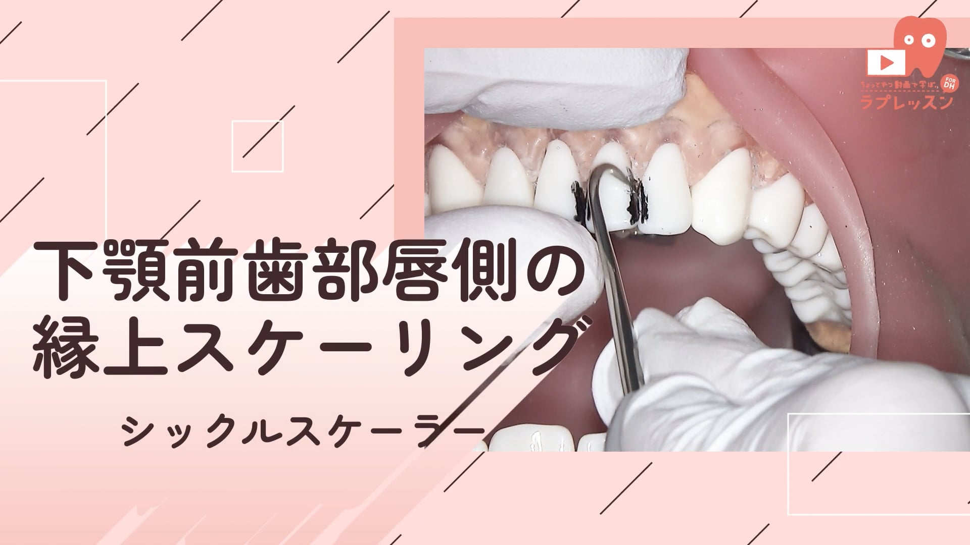 02.下顎前歯部唇側の縁上スケーリング