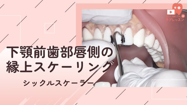 02.下顎前歯部唇側の縁上スケーリング