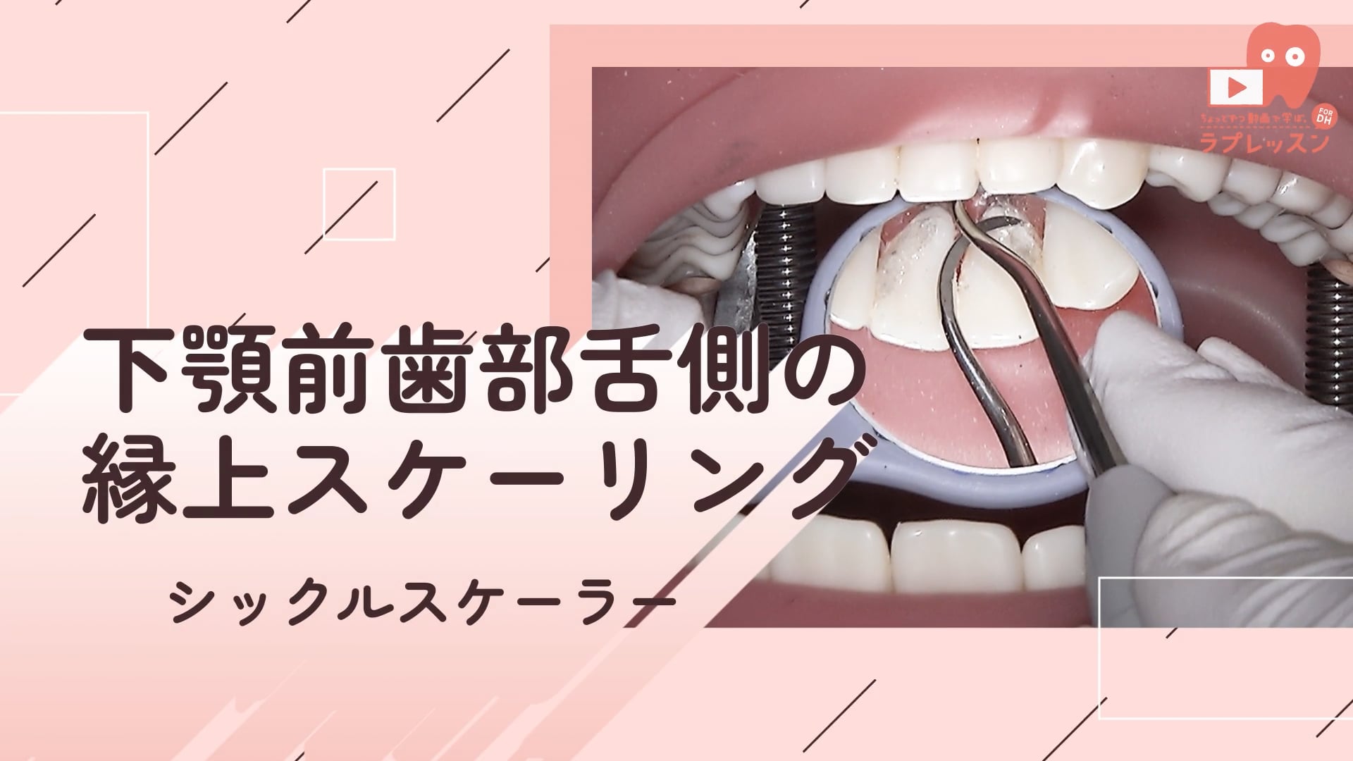 03.下顎前歯部舌側の縁上スケーリング