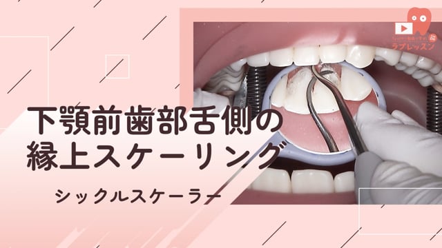 03.下顎前歯部舌側の縁上スケーリング