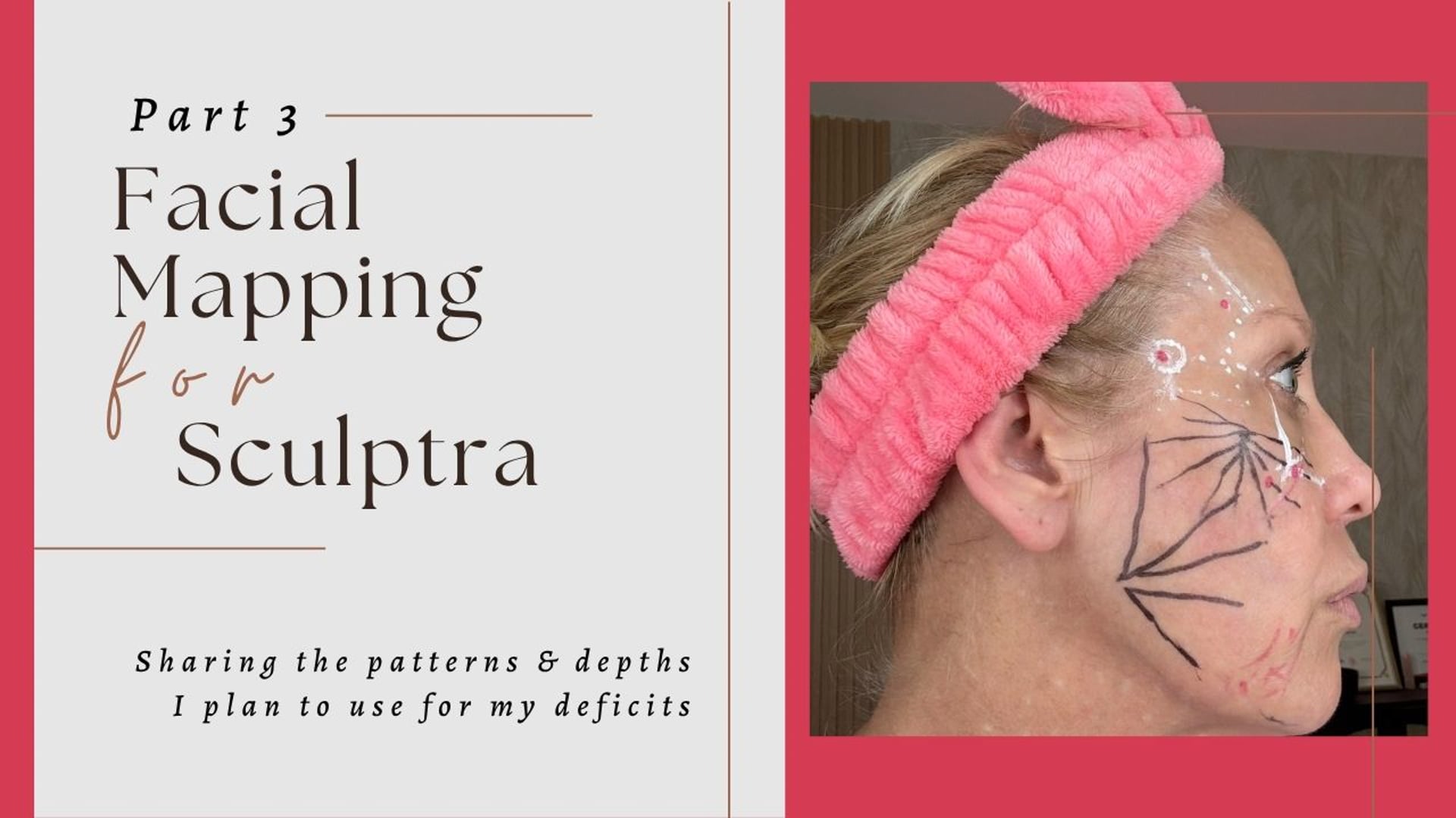 Part 3 Facial Mapping: How I Map Deep & Superficial Fat Pads for Full Facial Structure  (Needle + Cannula Technique)
