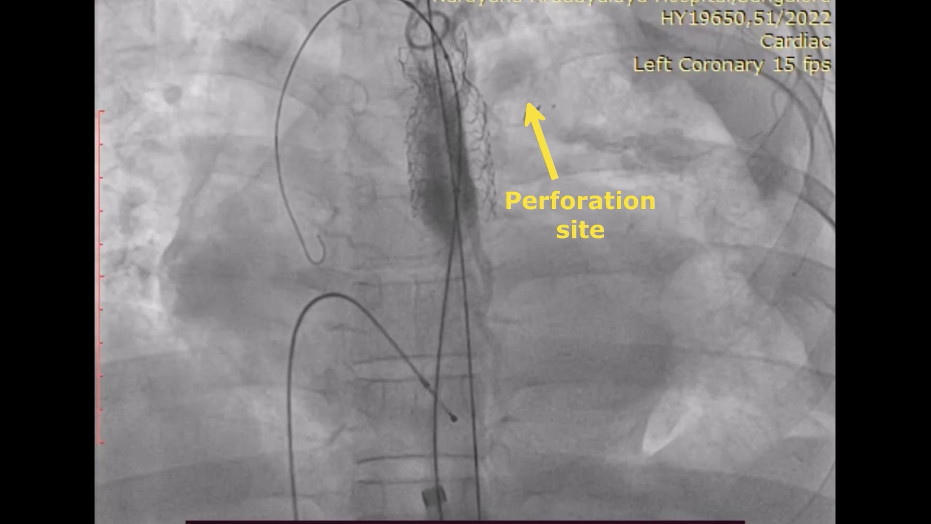 Hybrid approach for aortic rupture during balloon coarctoplasty | MMCTS