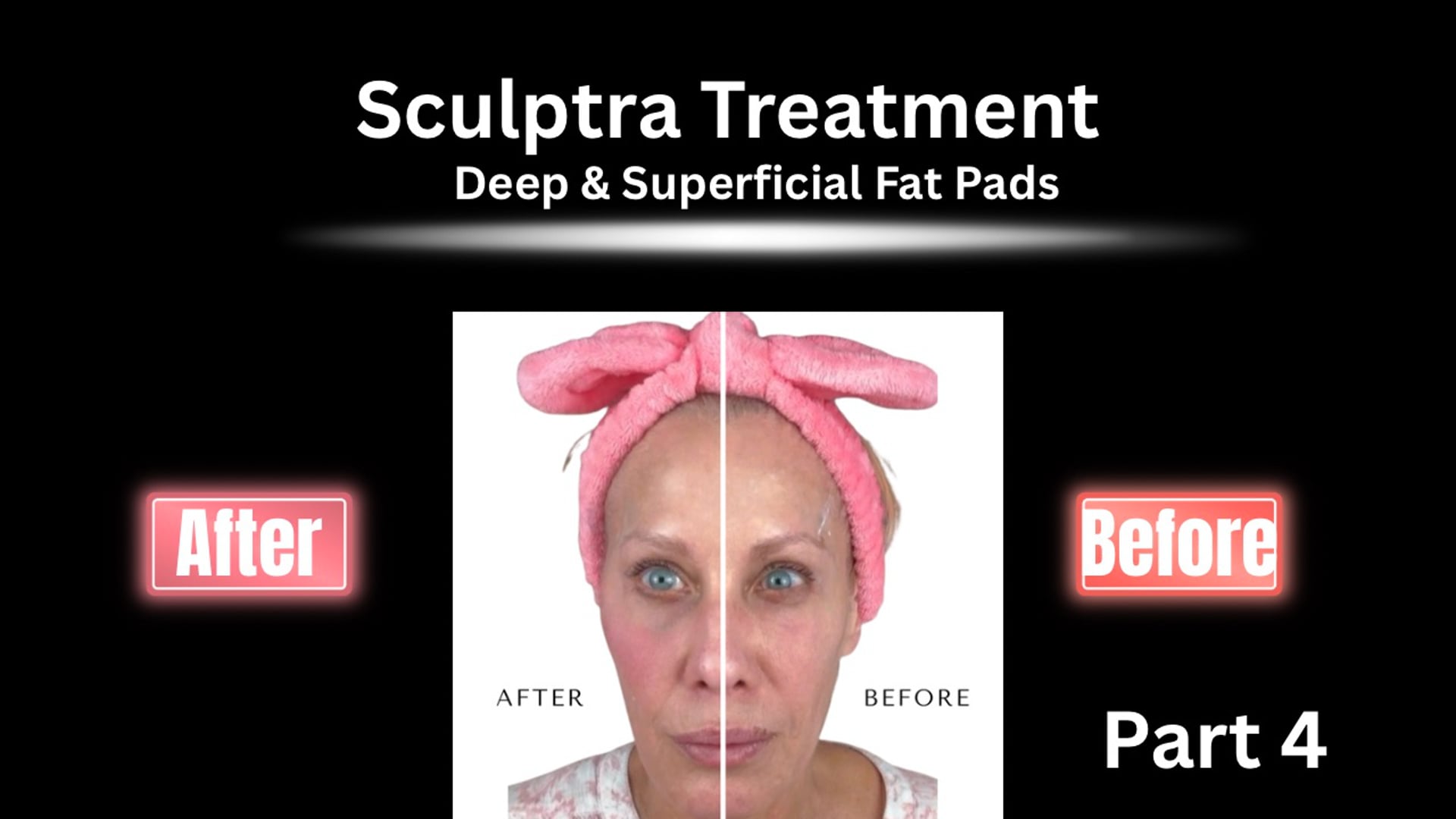 Sculptra Part 4: My Full Face Treatment (Deep & Superficial Fat Pads)