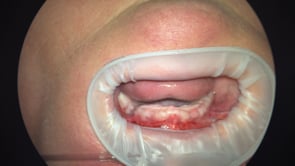 Upper Edentulous All-on-4