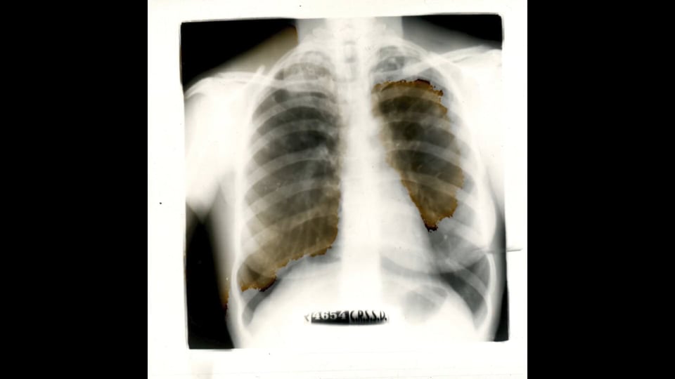 peugeot pulmonaire